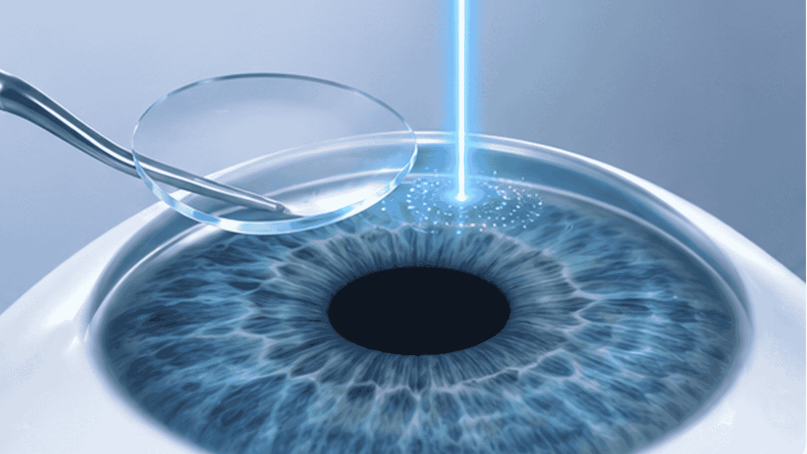 LASIK
