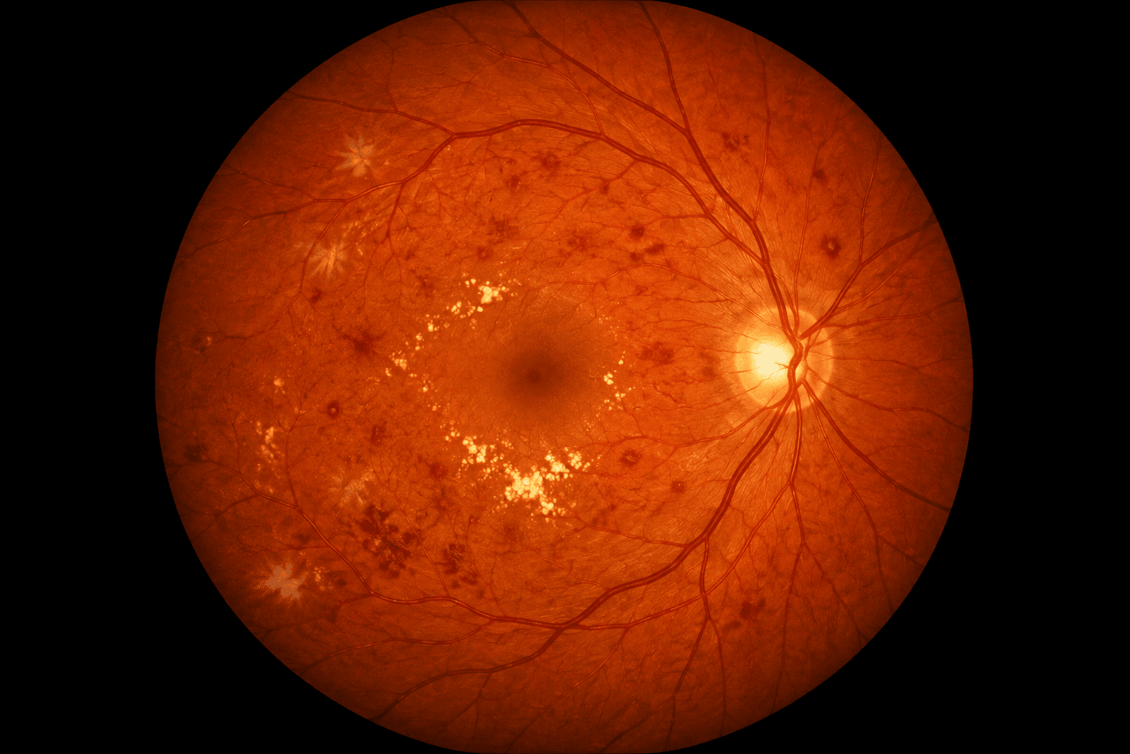Intravitreal Injections